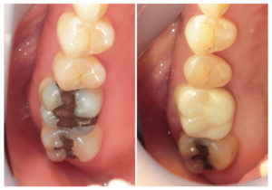 ジルコニアクラウンへ