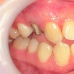 オールセラミックジルコニアＣｒ