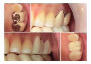 ジルコニアクラウン