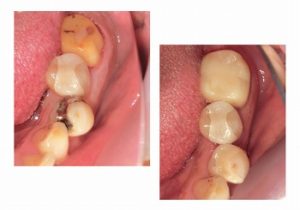 ジルコニアクラウンとジルコニアインレー