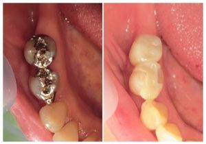 ジルコニアインレーとジルコニアクラウン