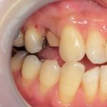 ジルコニアクラウン