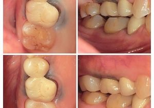 ジルコニアクラウン