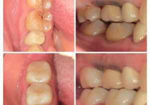 ジルコニアクラウンへ