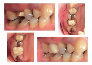 ジルコニアクラウン