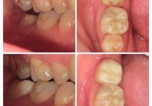 ジルコニアクラウン