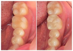 ジルコニアインレー