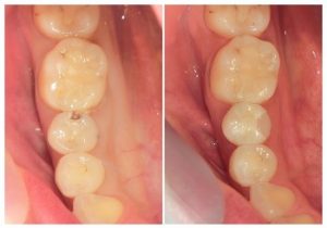 ジルコニアインレー