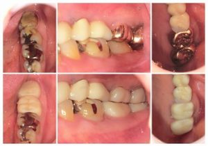 ジルコニアクラウン