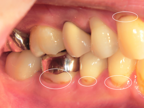 50代の45％にある根面う蝕って？