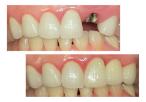 レアリングタイプのブリッジ