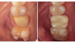 ジルコニアインレーとジルコニアクラウン