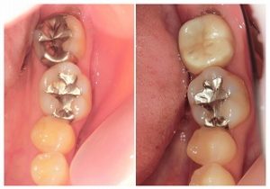 ジルコニアクラウンへ