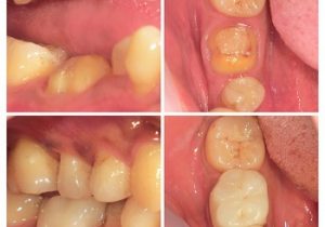 ジルコニアモノコッククラウン