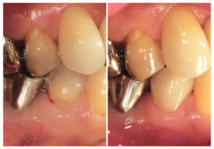 ジルコニアクラウンへ