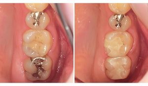 ジルコニアインレーへ