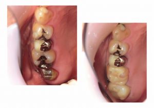 ジルコニアインレーとジルコニアクラウン