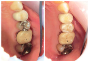 ジルコニアインレー