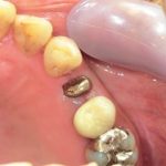 樹脂の歯からジルコニアへ