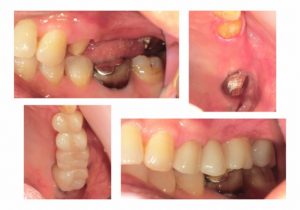 ジルコニアクラウンブリッジへ