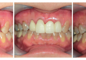 レアリングタイプのＢｒ