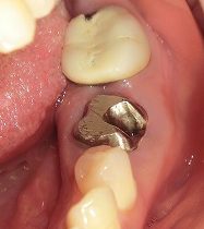 ジルコニアＣｒ