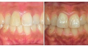 オールセラミック~レアリング~