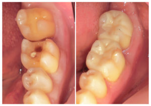 ジルコニアインレーへ