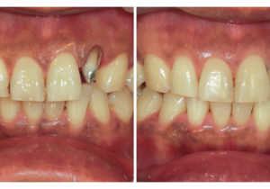 レアリングタイプ