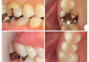 ジルコニアクラウンへ