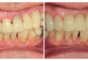 ジルコニアクラウンで連結