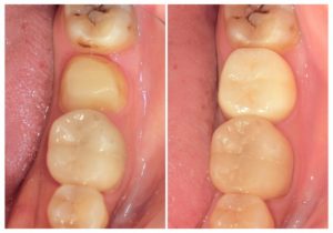 ジルコニアクラウンへ