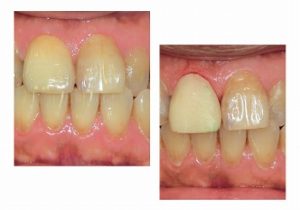 レアリングタイプのクラウン