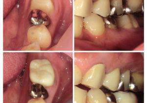 ジルコニアクラウンへ