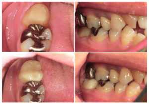 ジルコニアクラウンへ