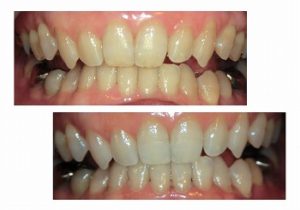 ホームホワイトニング