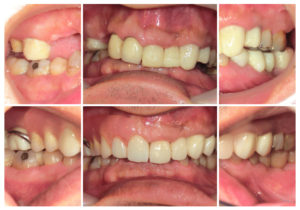 レアリングタイプ・ジルコニアクラウン・ノンクラスプデンチャー