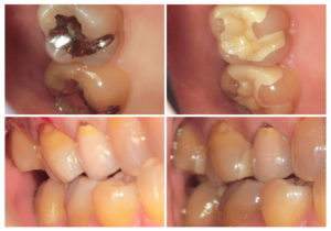 ジルコニアインレー