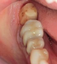 無痛で虫歯処置