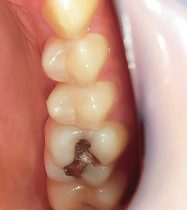 ジルコニアインレー