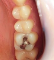 ジルコニアインレー