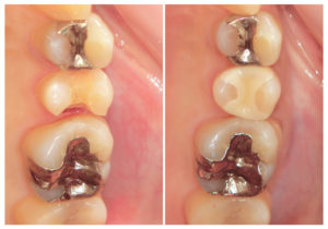 ジルコニアインレー