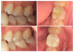 ジルコニアクラウンへ