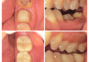 ジルコニアクラウンへ