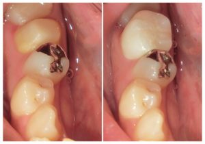 ジルコニアクラウンへ