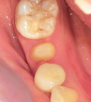 銀歯が外れた・・・