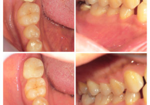 ジルコニアクラウン