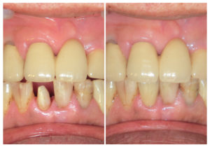 ジルコニアクラウン