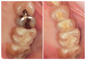 ジルコニアインレー