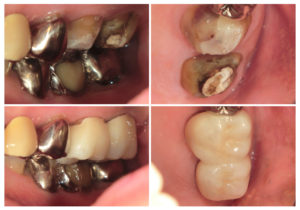 ジルコニアクラウン